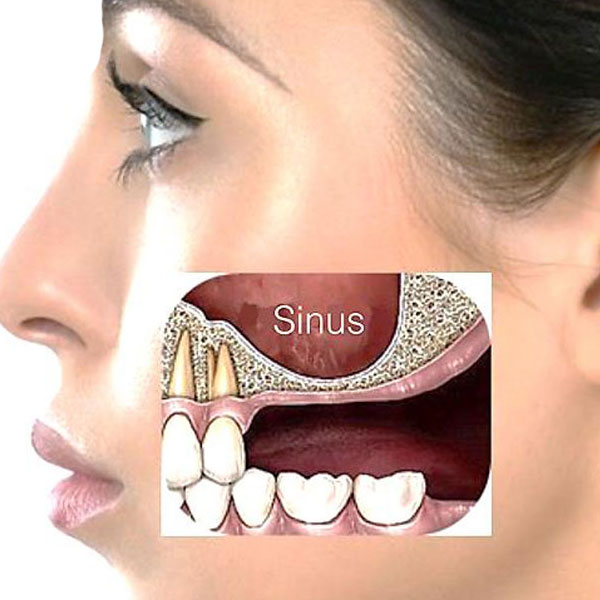 Sinus Lift