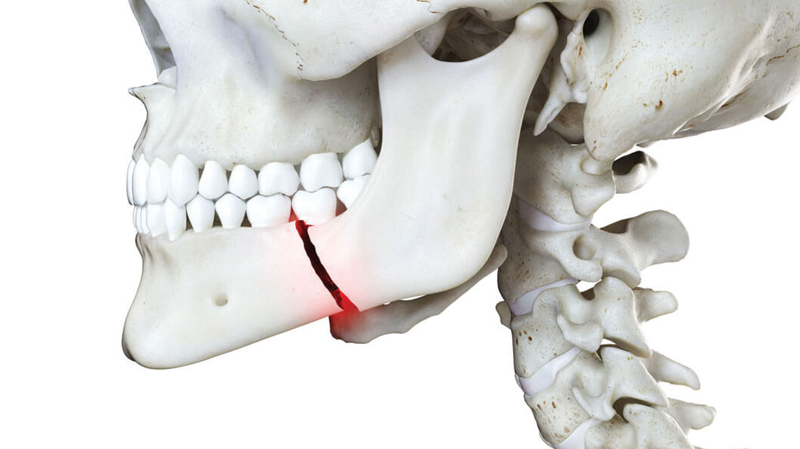 facial trauma