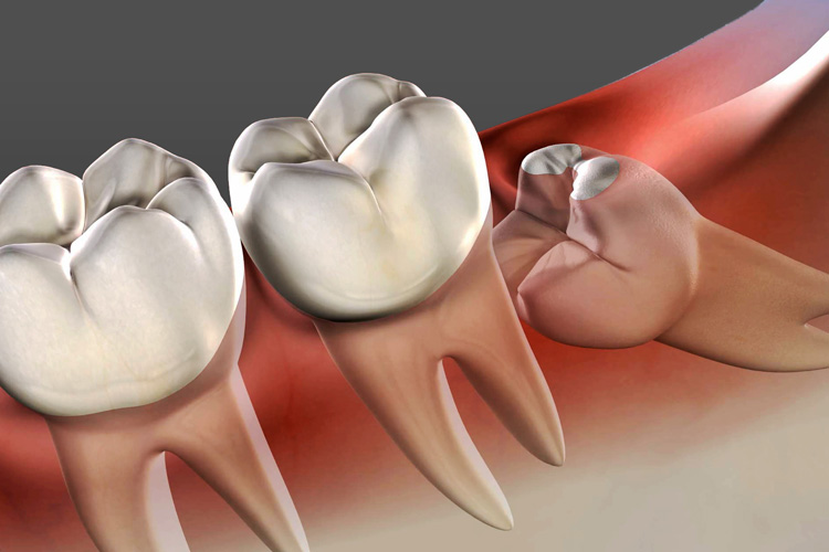wisdom teeth removal