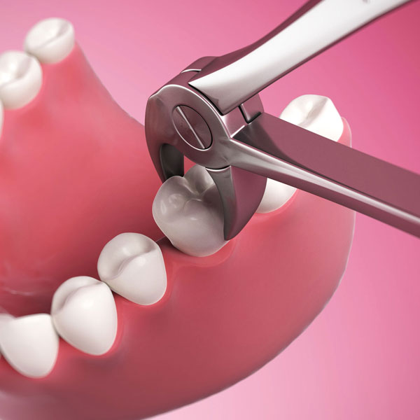 tooth extraction